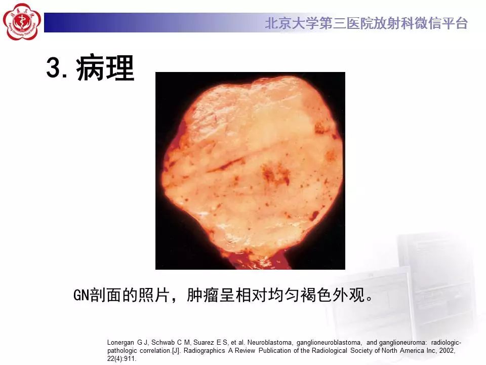 【病例】纵隔节细胞神经瘤1例CT影像表现