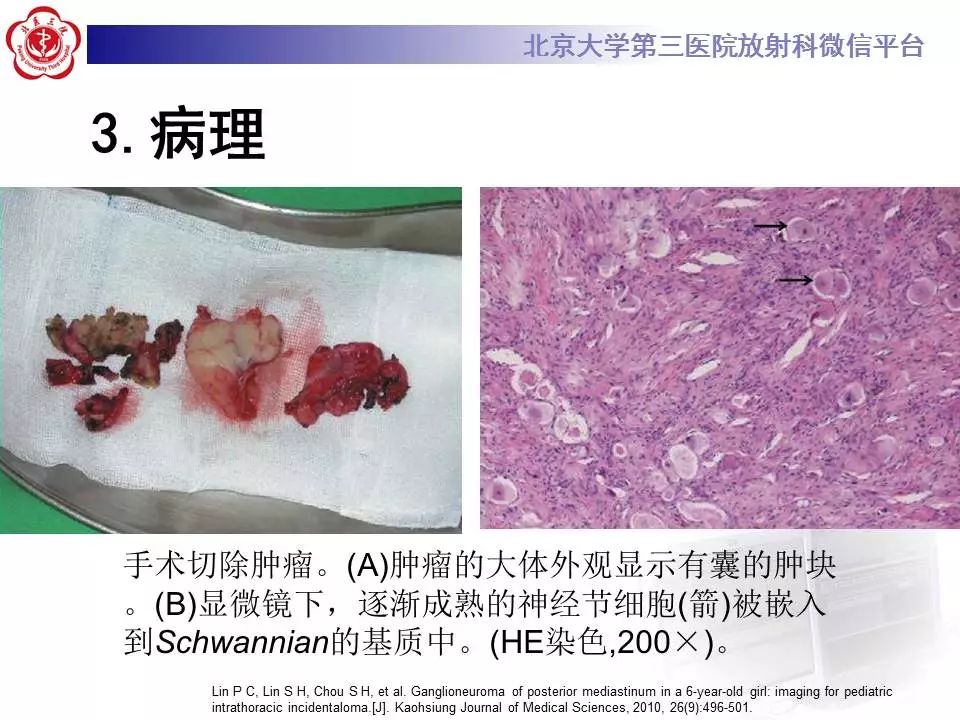 【病例】纵隔节细胞神经瘤1例CT影像表现