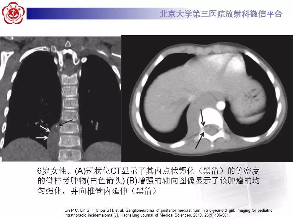【病例】纵隔节细胞神经瘤1例CT影像表现