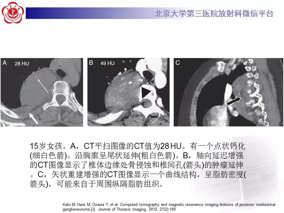 【病例】纵隔节细胞神经瘤1例CT影像表现