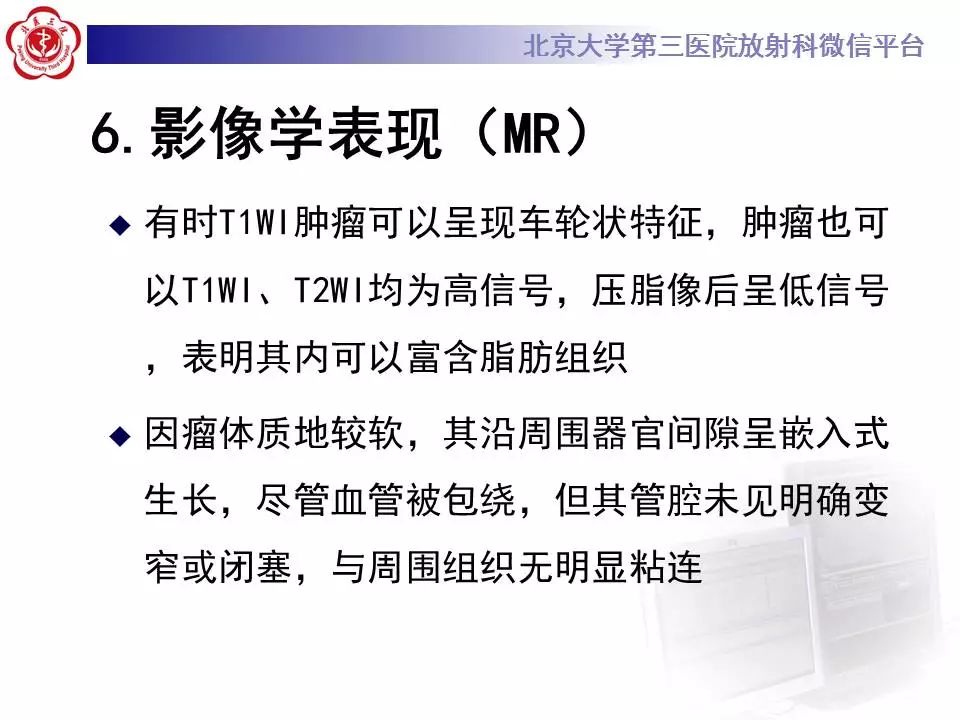【病例】纵隔节细胞神经瘤1例CT影像表现