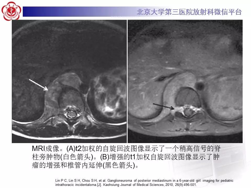【病例】纵隔节细胞神经瘤1例CT影像表现