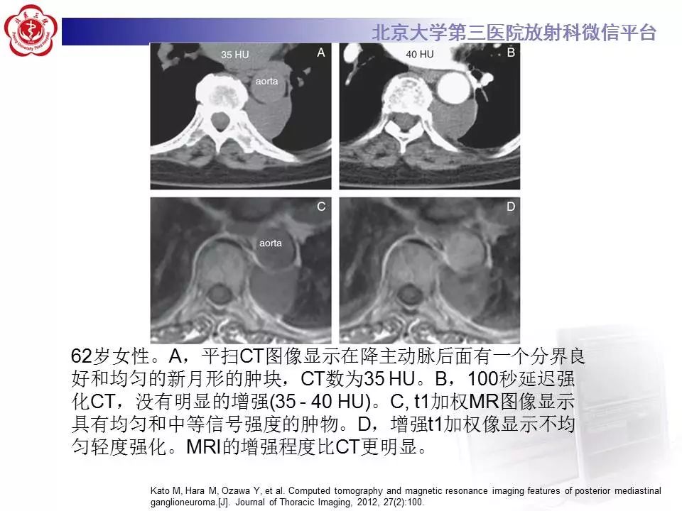 【病例】纵隔节细胞神经瘤1例CT影像表现