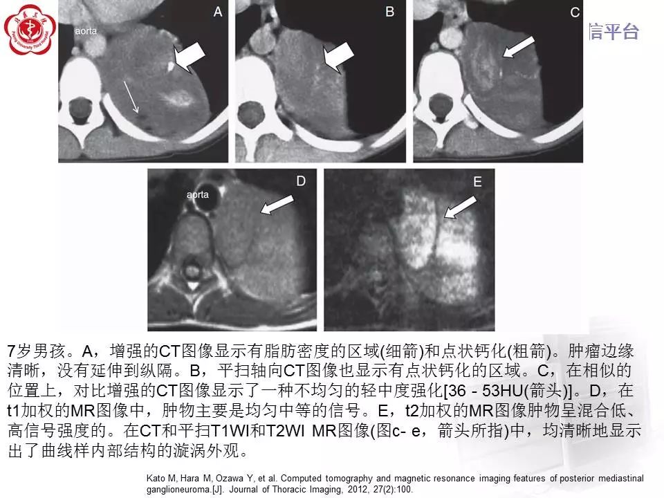 【病例】纵隔节细胞神经瘤1例CT影像表现