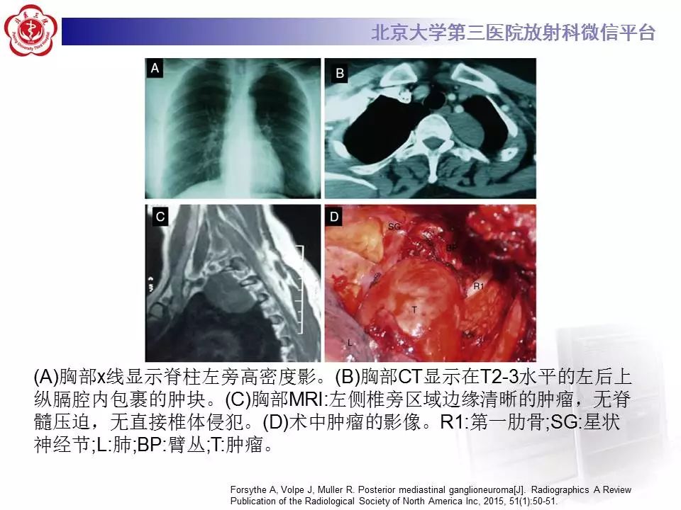 【病例】纵隔节细胞神经瘤1例CT影像表现