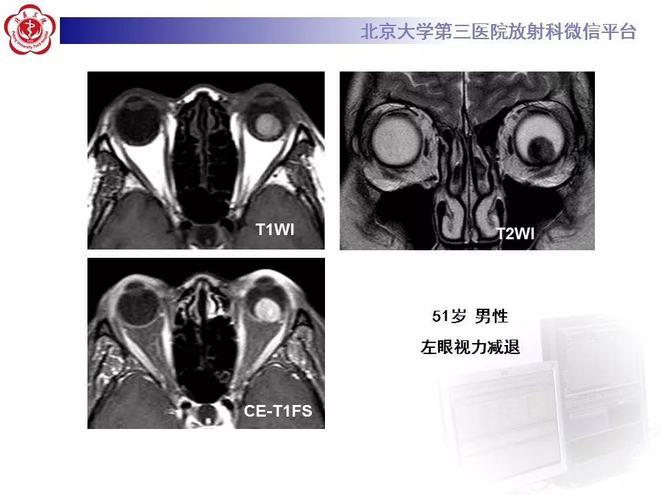 【PPT】色素膜黑色素瘤