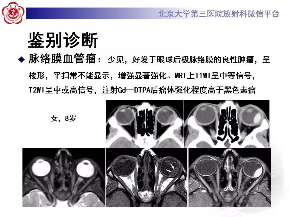 【PPT】色素膜黑色素瘤