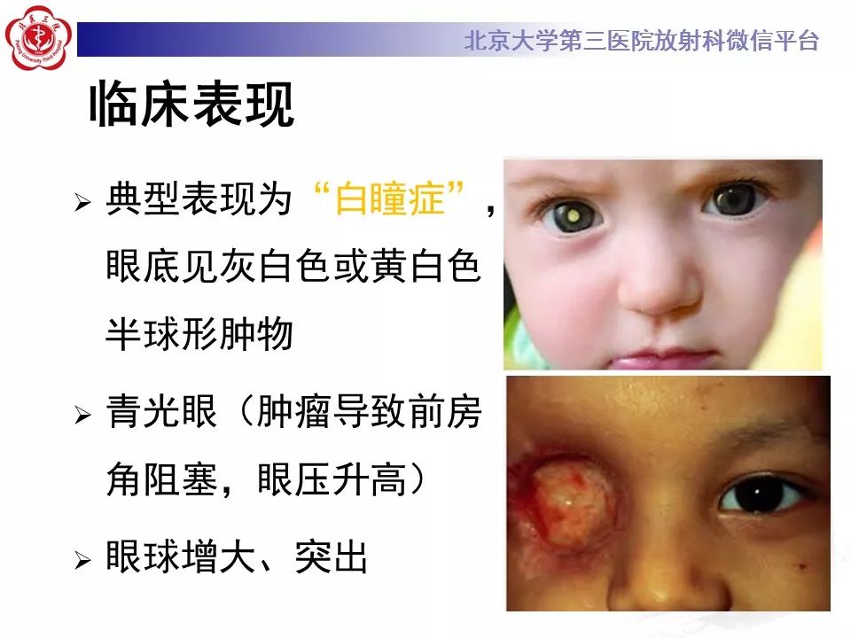 【PPT】色素膜黑色素瘤