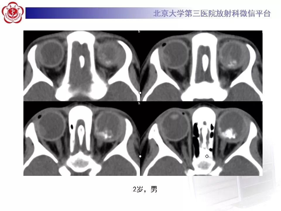 【PPT】色素膜黑色素瘤