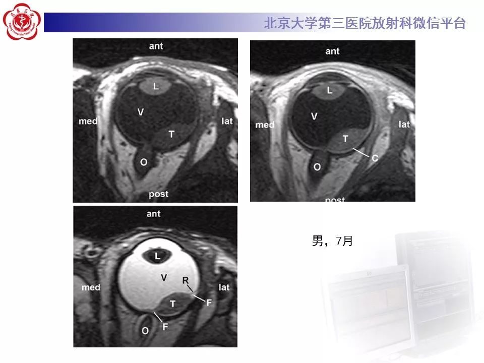 【PPT】色素膜黑色素瘤