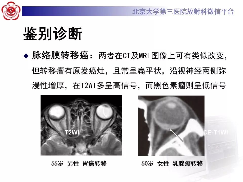 【PPT】色素膜黑色素瘤