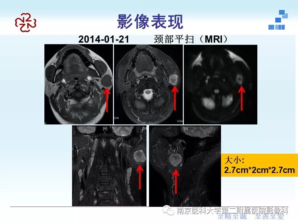 【PPT】专题读片—腮腺混合瘤的影像表现