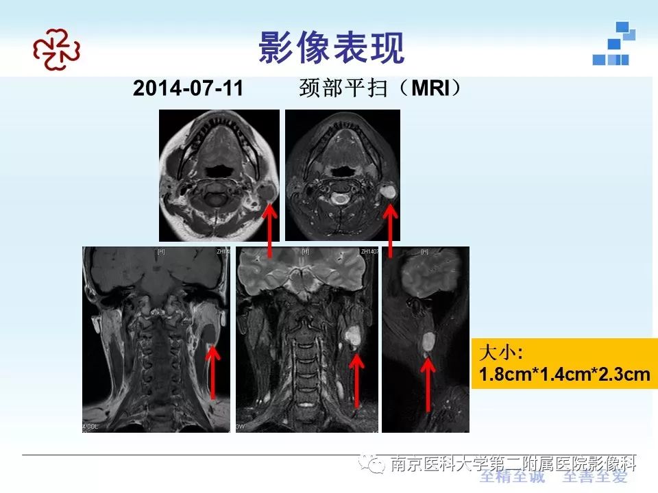 【PPT】专题读片—腮腺混合瘤的影像表现