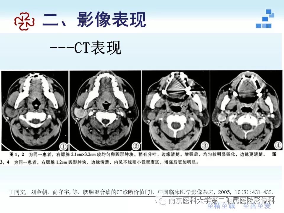 【PPT】专题读片—腮腺混合瘤的影像表现