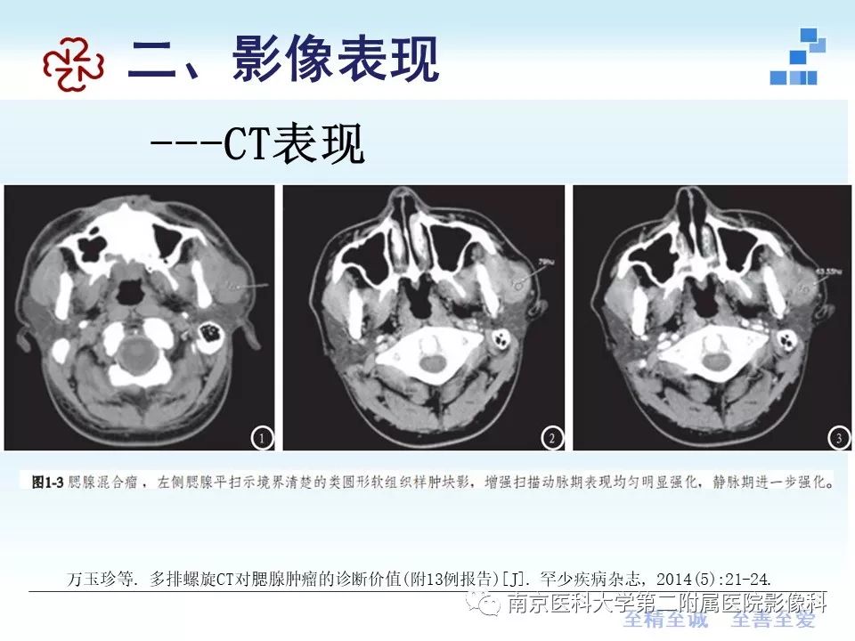 【PPT】专题读片—腮腺混合瘤的影像表现