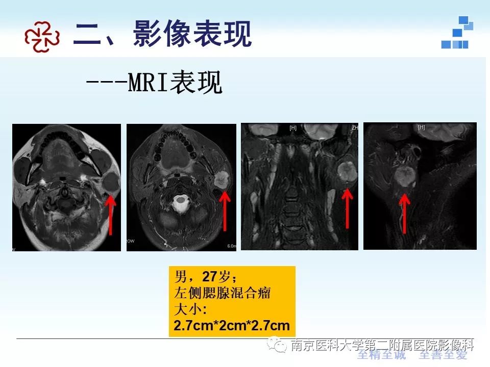 【PPT】专题读片—腮腺混合瘤的影像表现