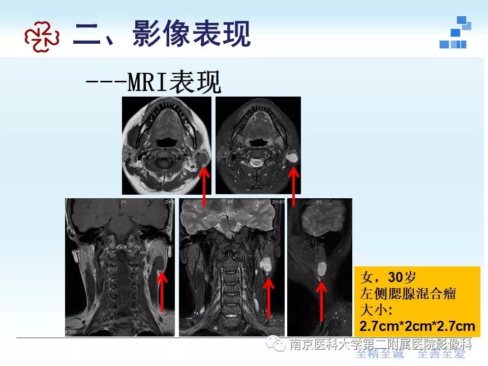 【PPT】专题读片—腮腺混合瘤的影像表现