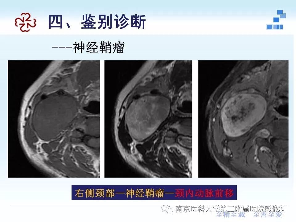 【PPT】专题读片—腮腺混合瘤的影像表现
