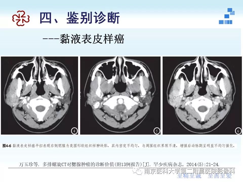 【PPT】专题读片—腮腺混合瘤的影像表现