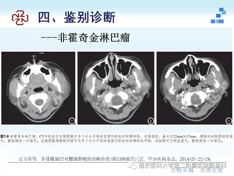 【PPT】专题读片—腮腺混合瘤的影像表现