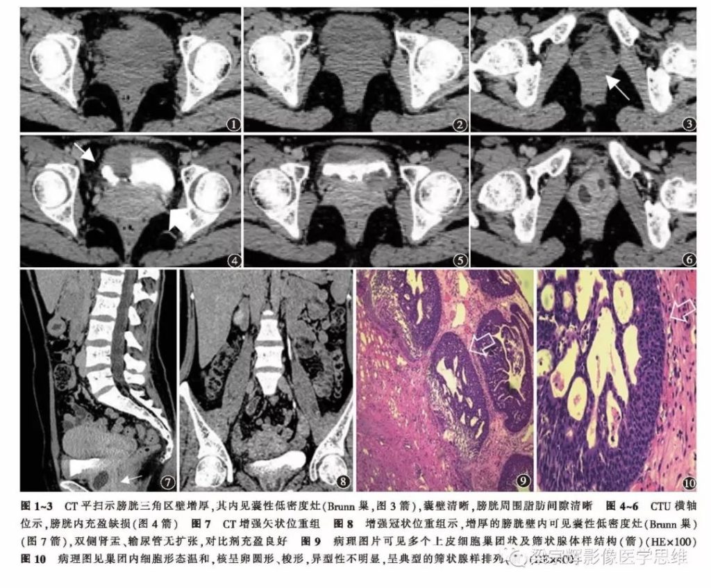 【病例】膀胱壁增厚性病变—腺性膀胱炎的诊断思维