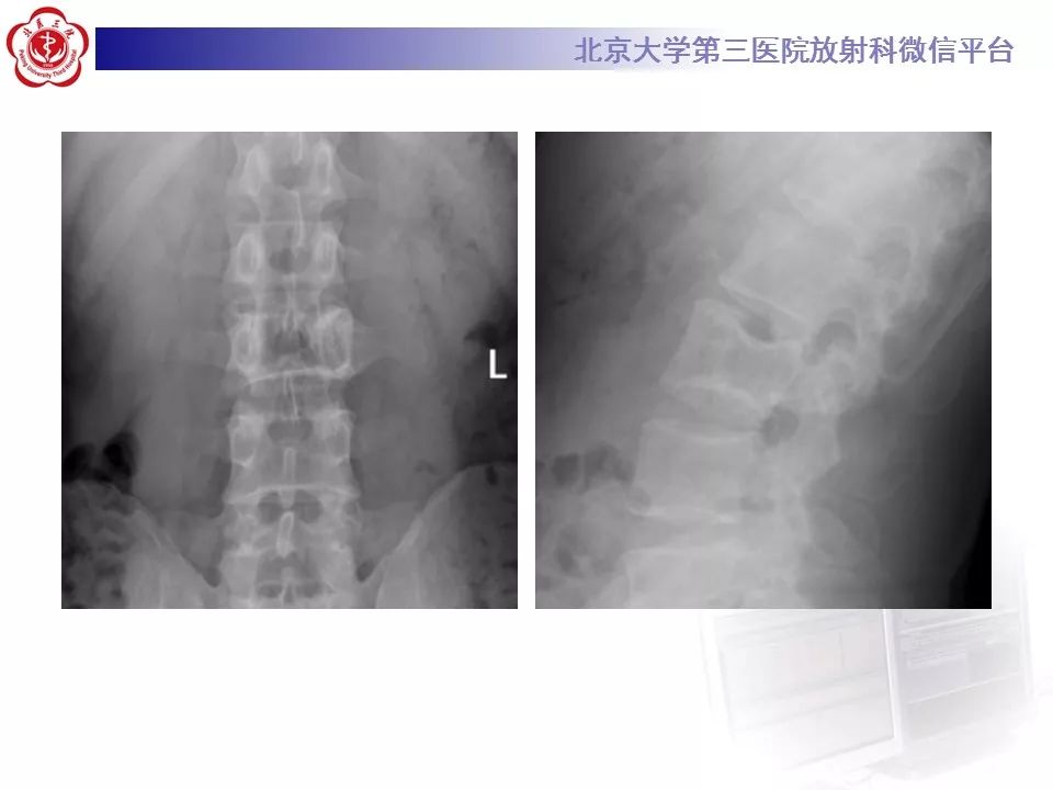 【病例】脊柱良性纤维组织细胞瘤1例CT及MR