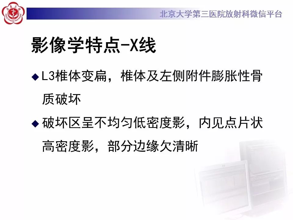 【病例】脊柱良性纤维组织细胞瘤1例CT及MR
