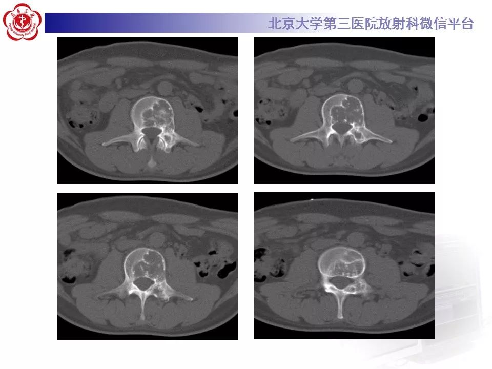 【病例】脊柱良性纤维组织细胞瘤1例CT及MR
