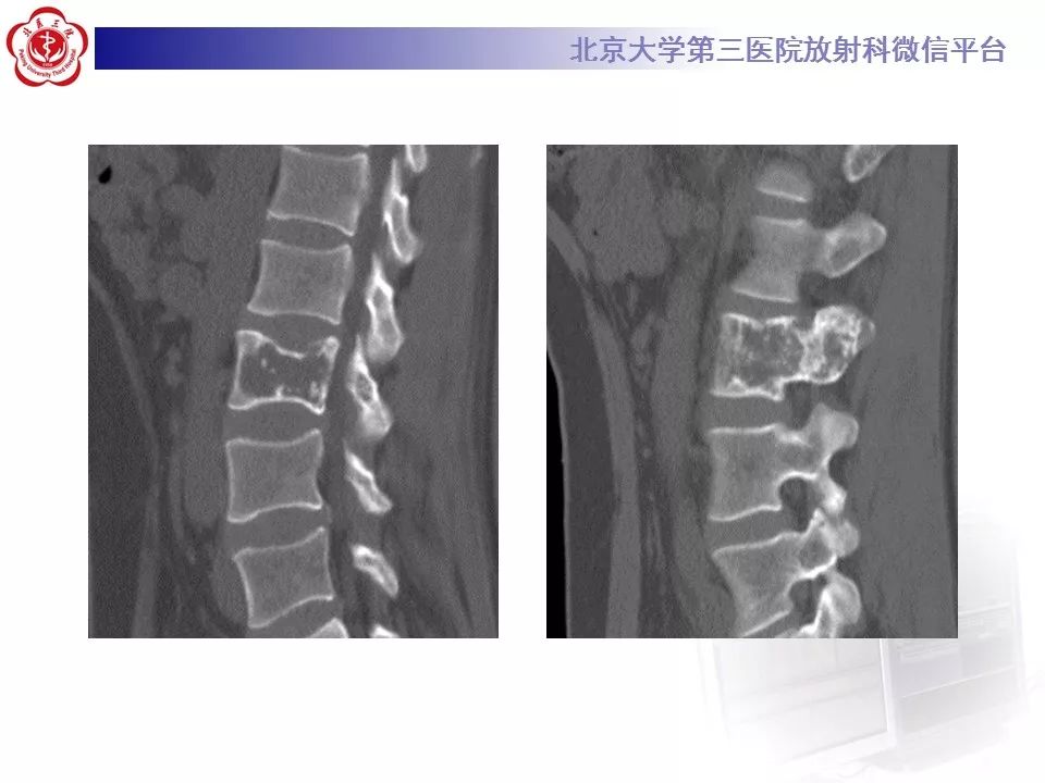 【病例】脊柱良性纤维组织细胞瘤1例CT及MR