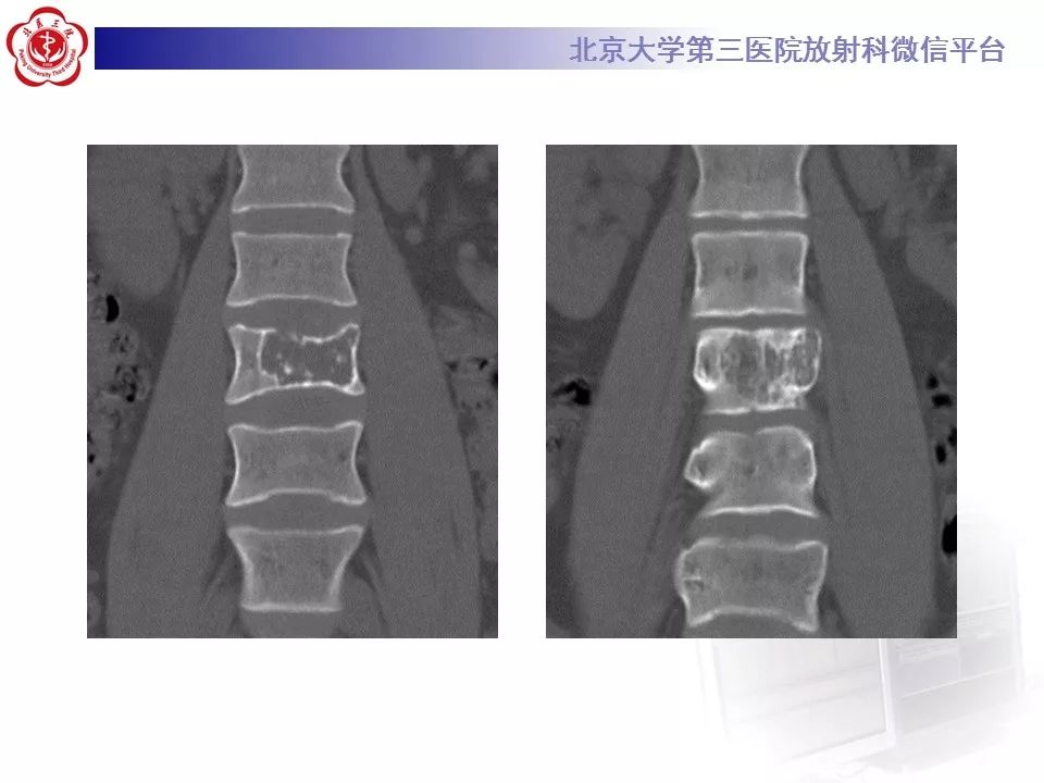 【病例】脊柱良性纤维组织细胞瘤1例CT及MR