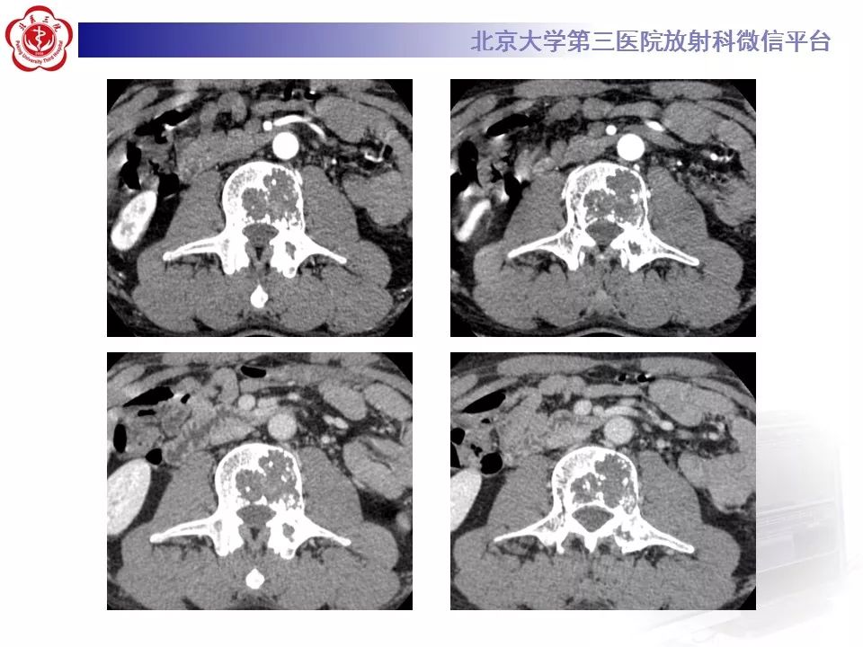 【病例】脊柱良性纤维组织细胞瘤1例CT及MR