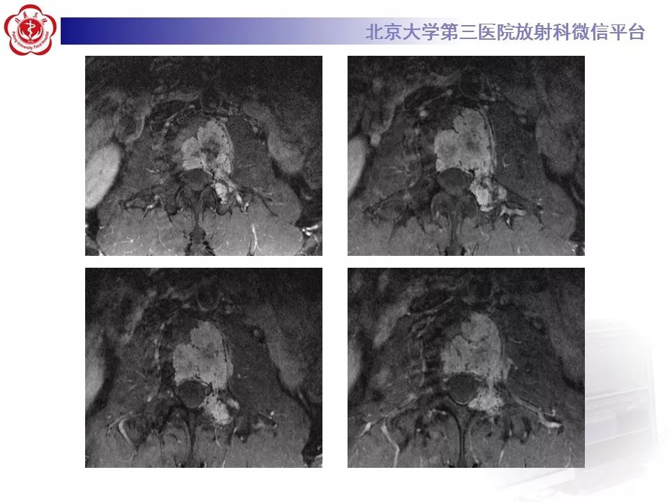 【病例】脊柱良性纤维组织细胞瘤1例CT及MR