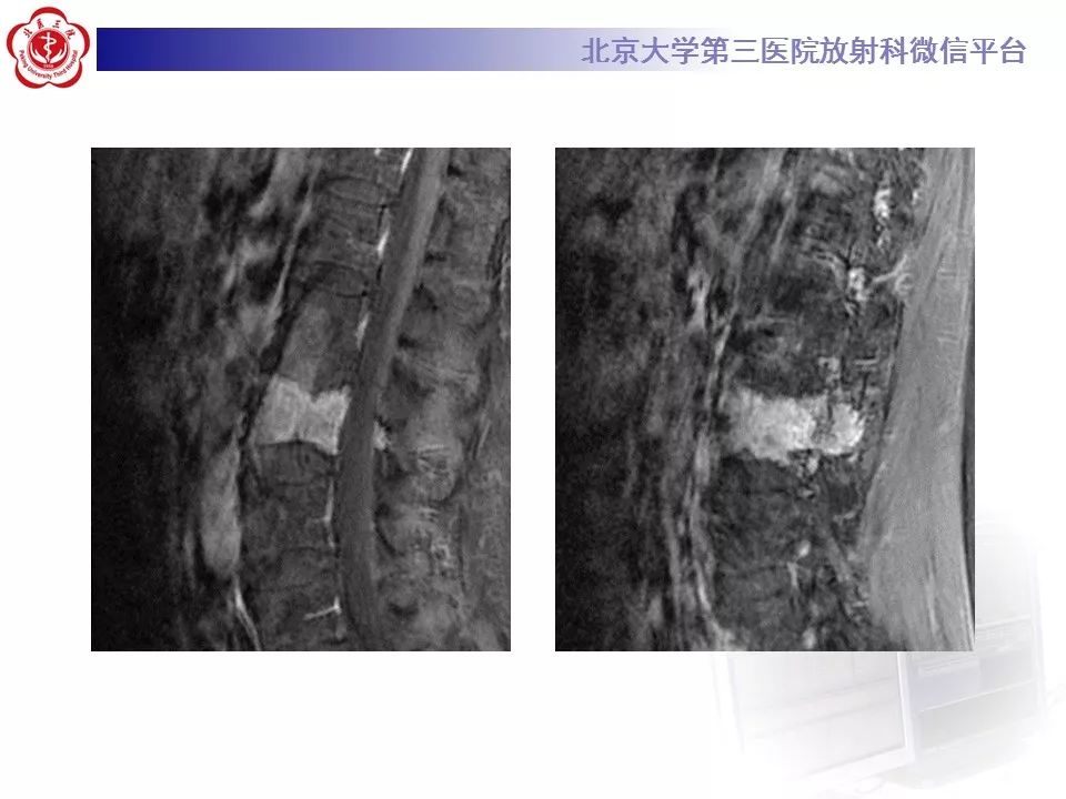 【病例】脊柱良性纤维组织细胞瘤1例CT及MR