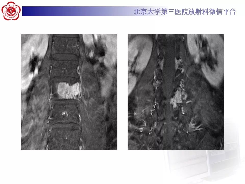 【病例】脊柱良性纤维组织细胞瘤1例CT及MR
