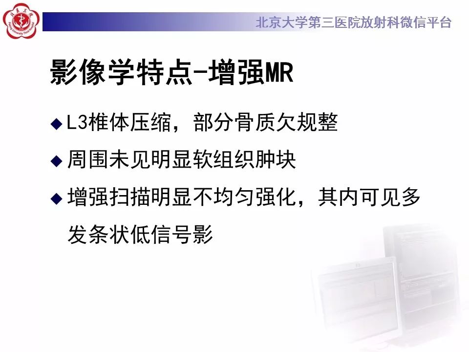【病例】脊柱良性纤维组织细胞瘤1例CT及MR