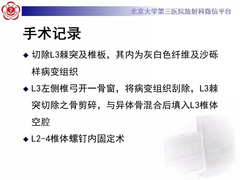 【病例】脊柱良性纤维组织细胞瘤1例CT及MR
