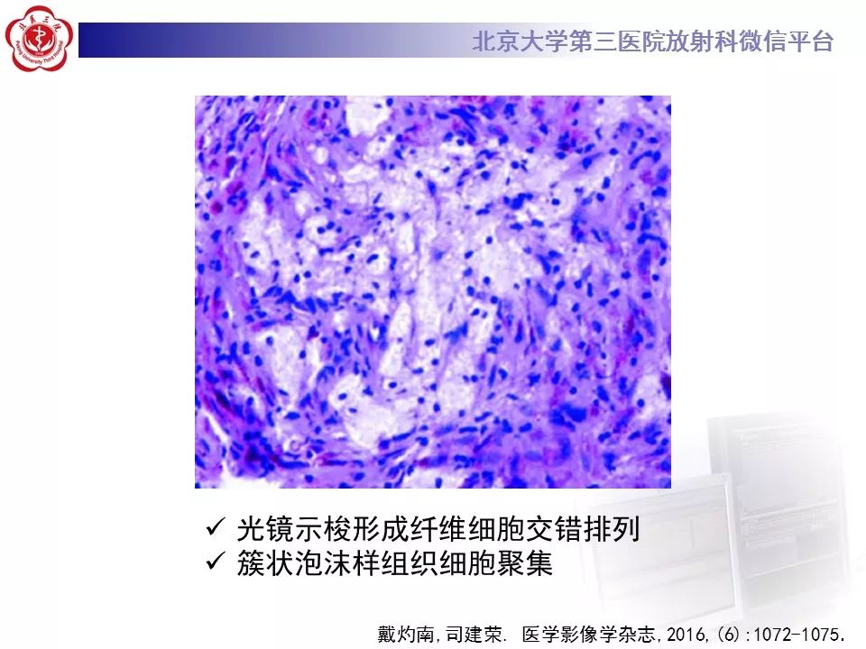 【病例】脊柱良性纤维组织细胞瘤1例CT及MR