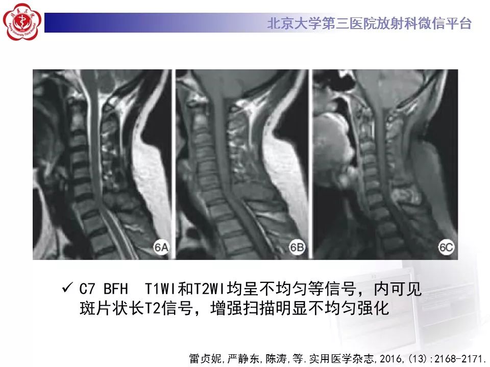 【病例】脊柱良性纤维组织细胞瘤1例CT及MR