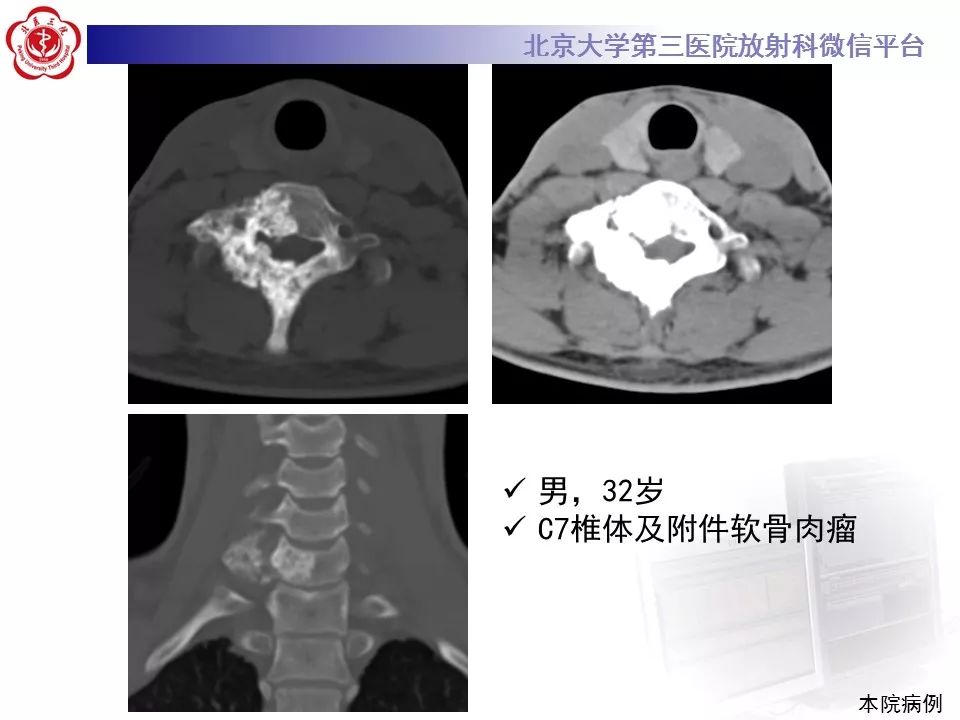 【病例】脊柱良性纤维组织细胞瘤1例CT及MR