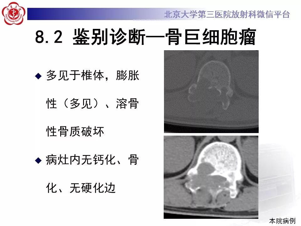 【病例】脊柱良性纤维组织细胞瘤1例CT及MR