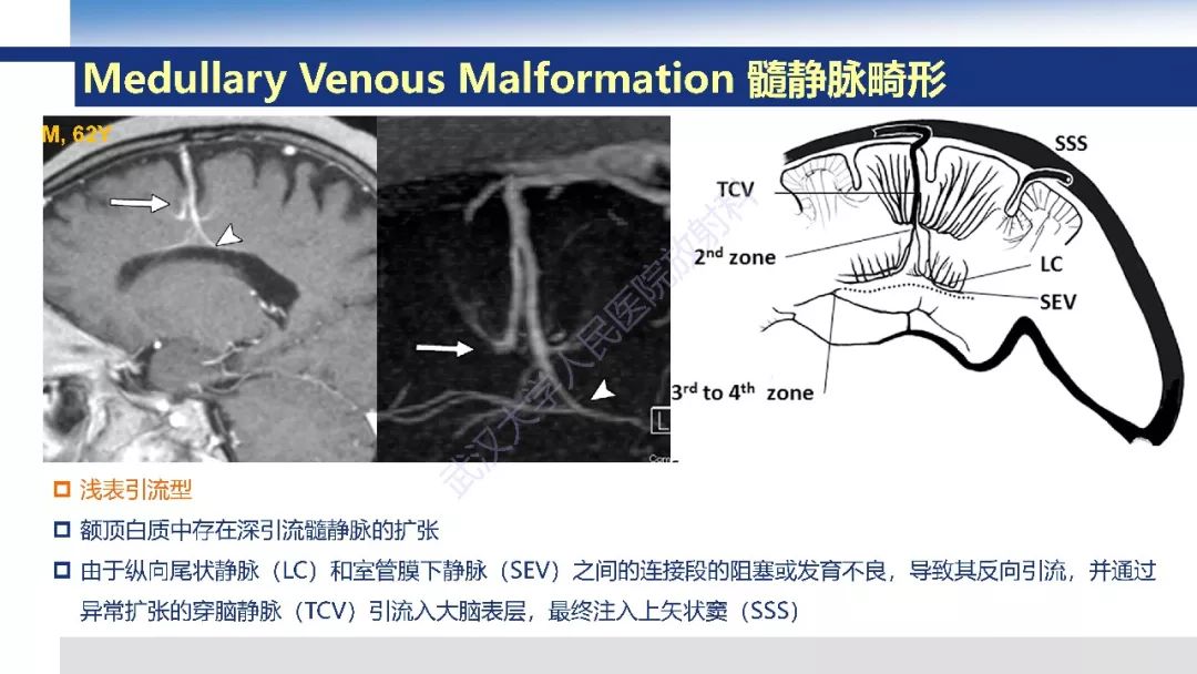 【PPT】大脑髓静脉解剖及疾病影像诊断