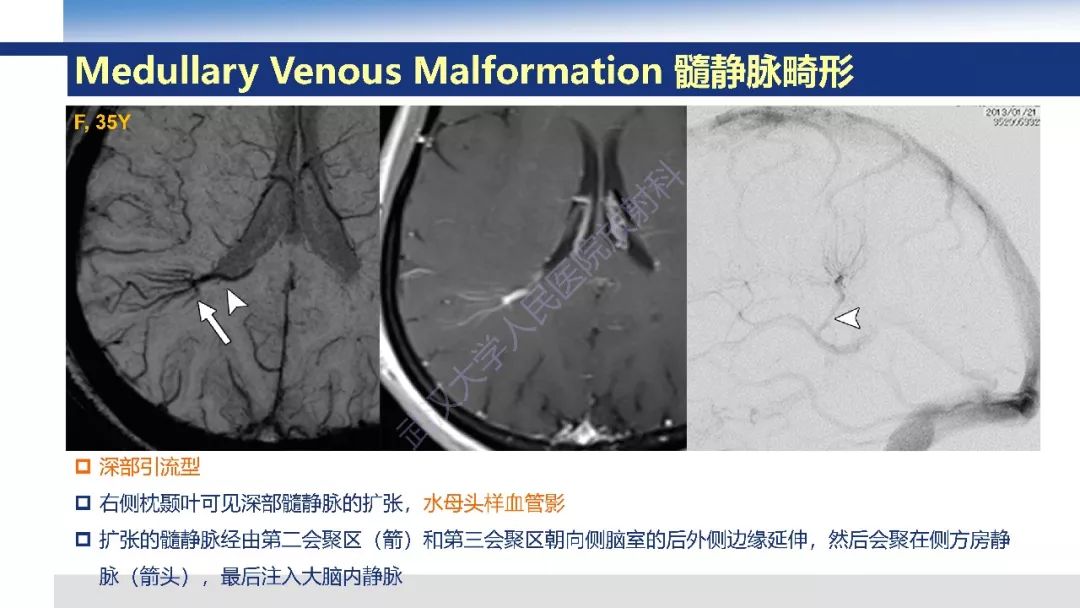 【PPT】大脑髓静脉解剖及疾病影像诊断
