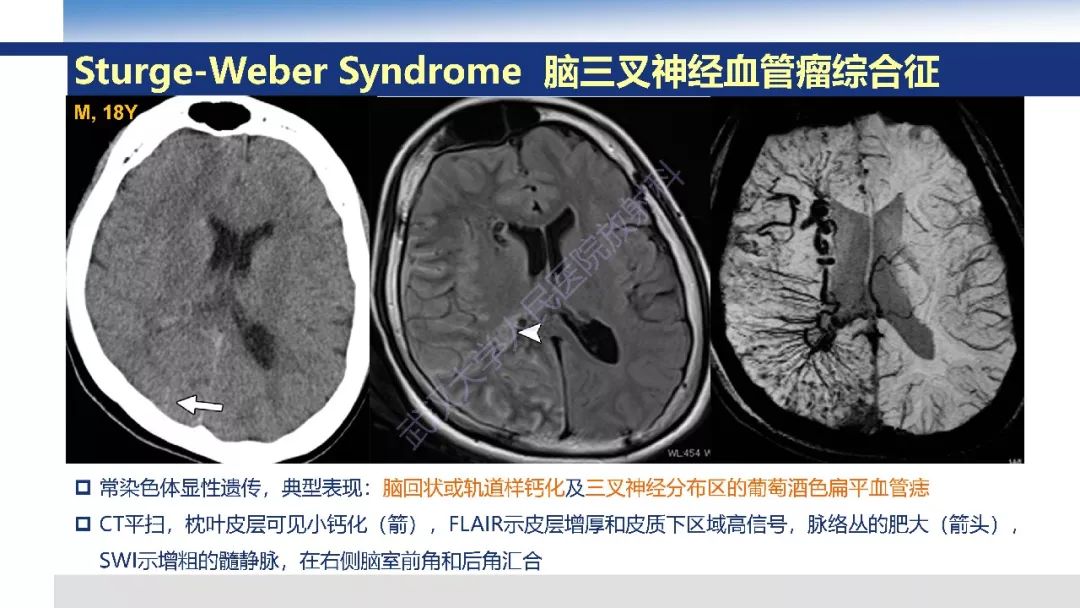 【PPT】大脑髓静脉解剖及疾病影像诊断