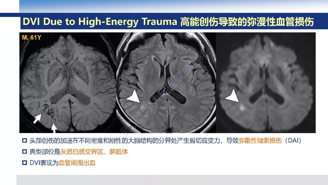 【PPT】大脑髓静脉解剖及疾病影像诊断