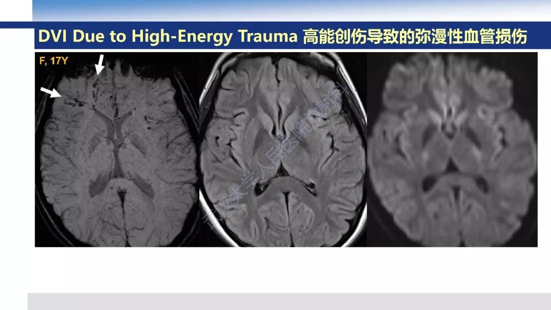 【PPT】大脑髓静脉解剖及疾病影像诊断