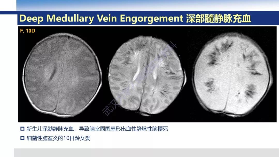 【PPT】大脑髓静脉解剖及疾病影像诊断