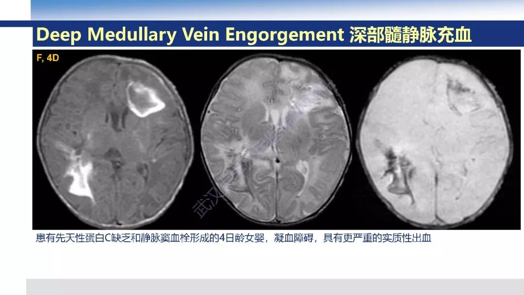 【PPT】大脑髓静脉解剖及疾病影像诊断