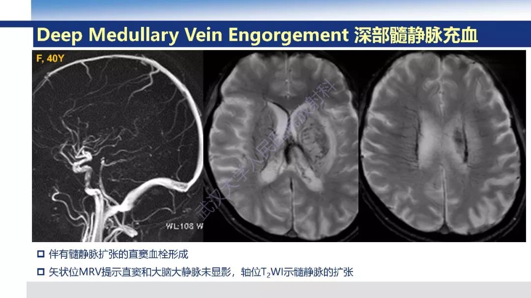 【PPT】大脑髓静脉解剖及疾病影像诊断