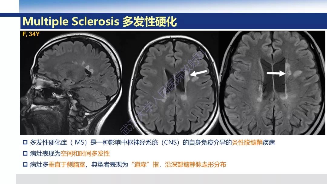 【PPT】大脑髓静脉解剖及疾病影像诊断