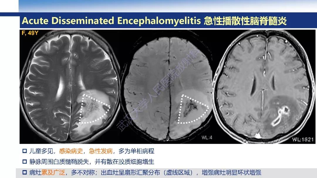 【PPT】大脑髓静脉解剖及疾病影像诊断